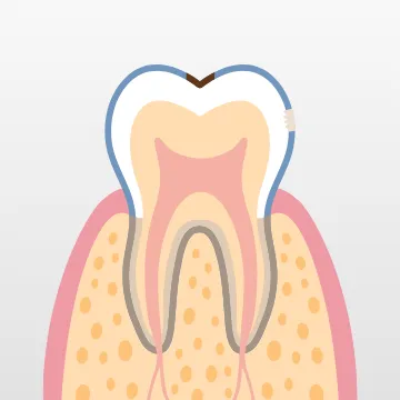 酸で歯の表面が荒れて白く濁った状態