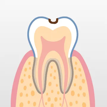 歯表面のエナメル質に穴が開き、黒や茶色に変色している段階
