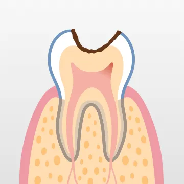 内部の象牙質まで進行した状態で、しみたり痛みを感じることがある