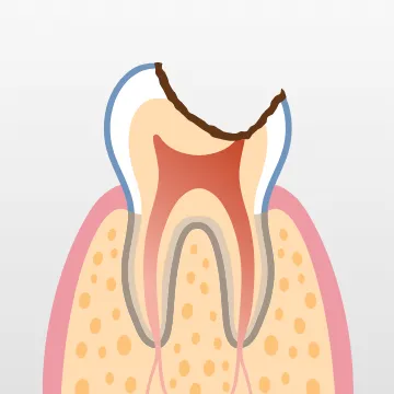 歯の神経まで達した状態で、根管治療が必要になる