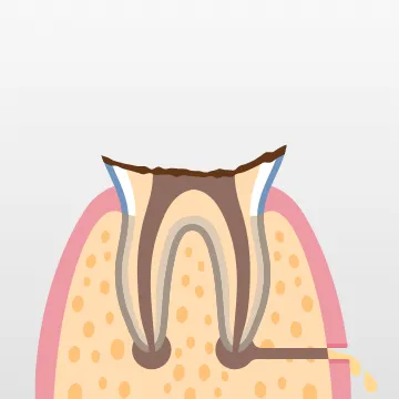 歯が大きく失われ、根だけが残る残根状態。根の先端部に感染が波及し、根尖病変ができることもある