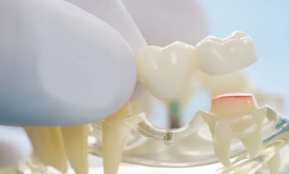 ブリッジのイメージ図