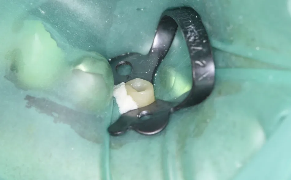 ラバーダム防湿