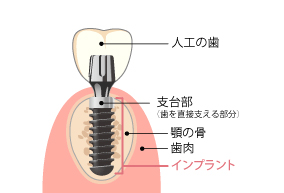 インプラントの構造