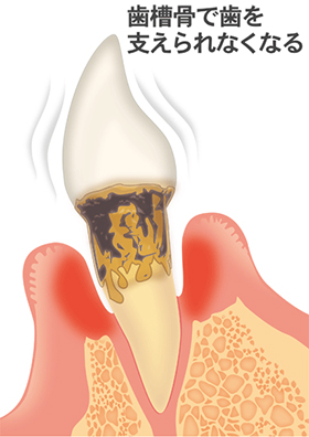 歯周病が進行すると